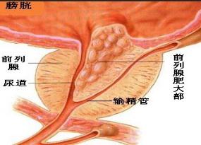 前列腺增生有哪些危害？