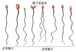 男性患有弱精症能不能生育?