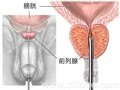 前列腺炎怎么形成的？