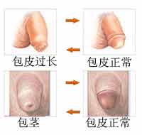 包皮过长是什么引起的？为什么会包皮过长?