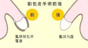 包皮过长会得前列腺炎吗？