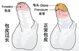 包皮过长怎么办?