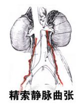 精索静脉曲张如何用饮食保健?