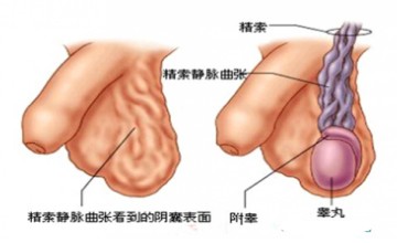 精索静脉曲张并发前列腺炎怎么办