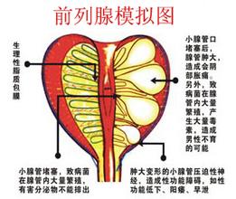 前列腺增生有哪些常见症状